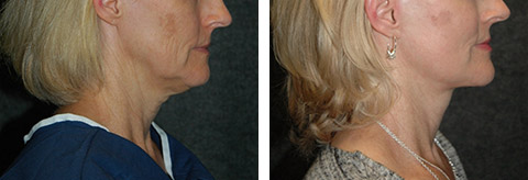 best lower facelift photos