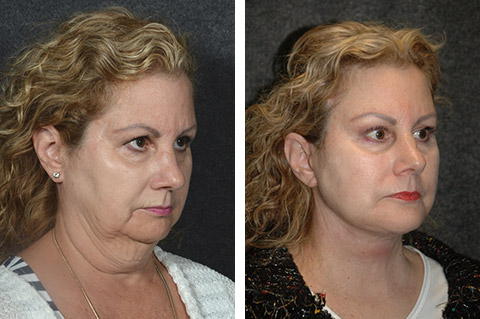 best lower facelift surgeon ny