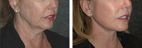 best lower facelift surgeon