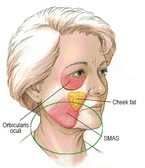 lower facelift diagram