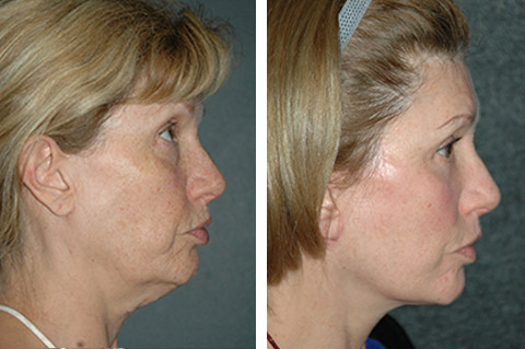 What is the importance of compression after facelift surgery?