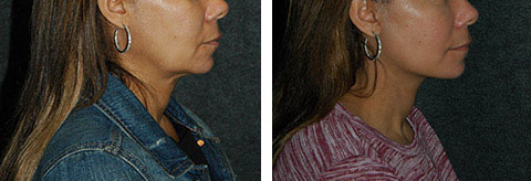 lower facelift pics