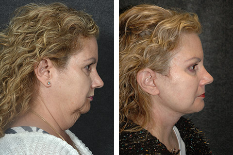 lower facelift surgery photo