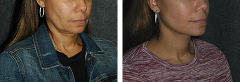 lower facelift surgery photos