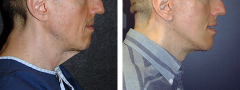 Male Facelift Photo Gallery - Facial Plastic Surgery