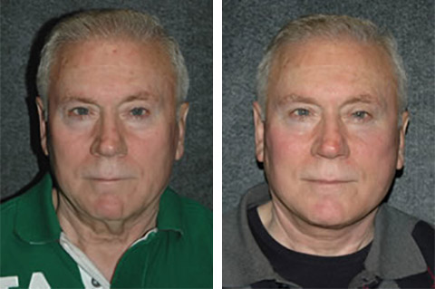 facelift for men photos