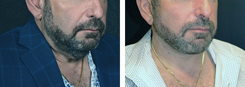 facelift for men