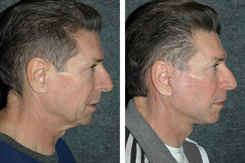 facelift surgery for men