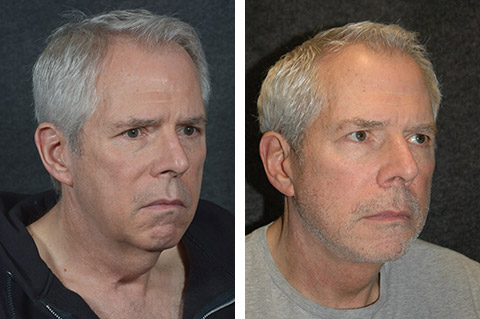 male facelift results