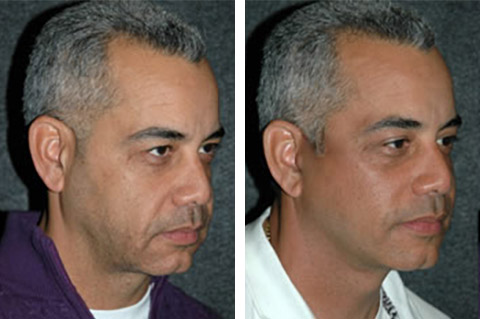 NYC Male Facelifts: Recovery and Transformation — Kassir Plastic Surgery in  NY and NJ