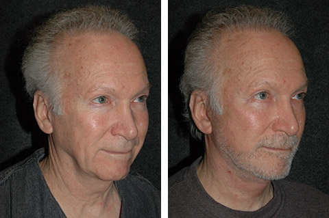 new york male face lift photos