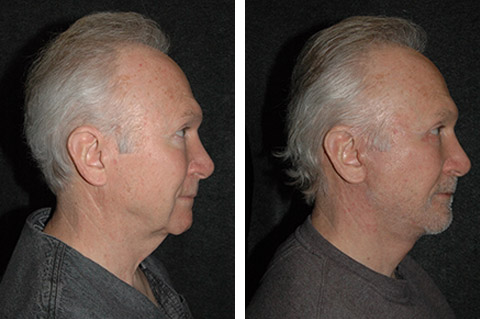 new york male face lift surgery