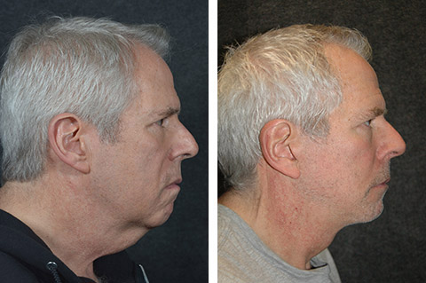 Male Neck Lift | Neck Rejuvenation for Men