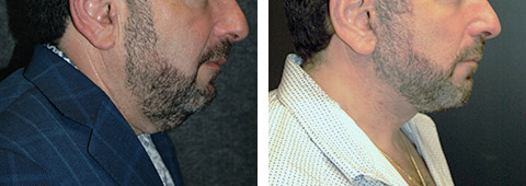 male necklift patient