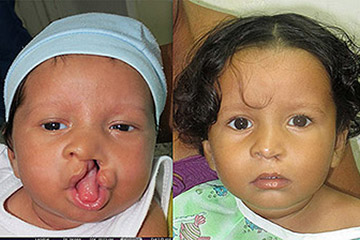 Young Boyr with Cleft Lip