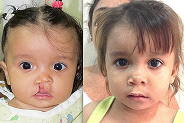 Cleft Lip Young Girl Before and After