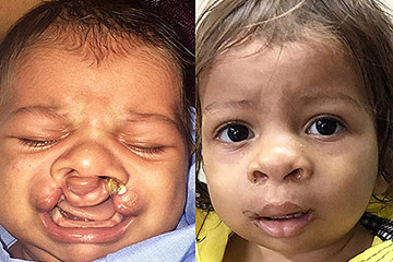 cleft palate repair post op