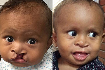 dr jacono cleft lip mission patient