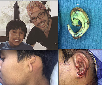 dr jacono microtia ear patient