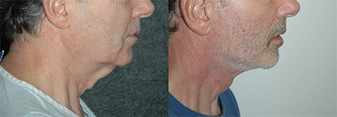 Male Neck Rejuvenation Before and After