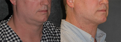 Neck Lift for Men Photos