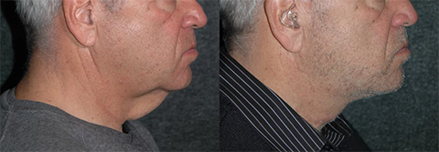 Neck Lift for Men