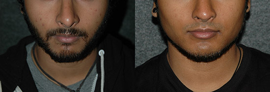 male jaw implant before and after