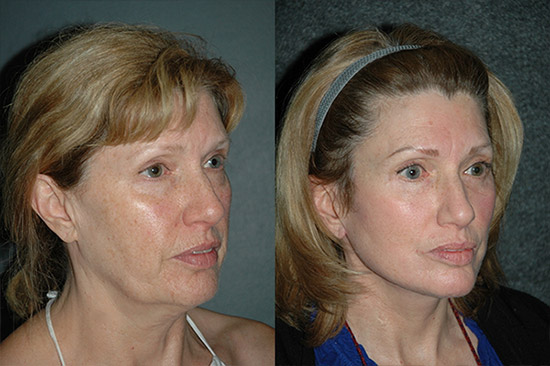 Facelift Photos Before and After