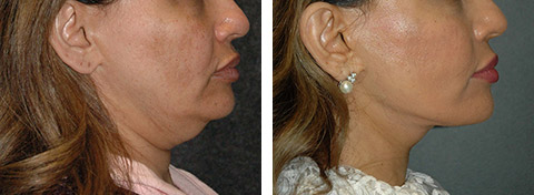 best revision facelift results nyc best revision facelift results nyc