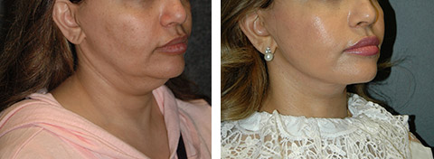 new york revision facelift results new york revision facelift results