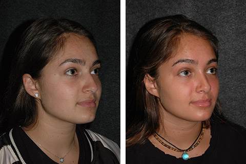 best new york teen rhinoplasty photos