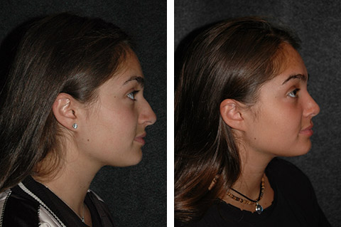 best new york teen rhinoplasty