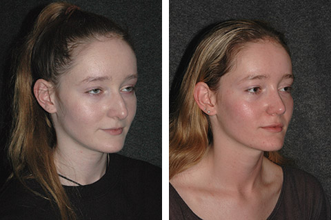 best rhinoplasty surgeon best rhinoplasty surgeon