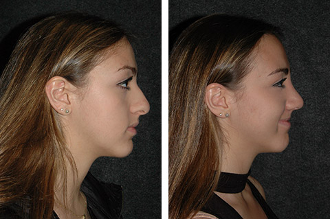 best teen rhinoplasty photos new york