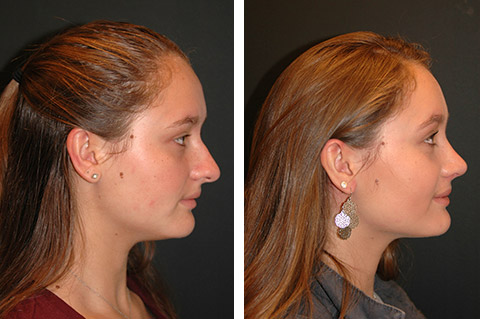 teen open rhinoplasty before and after patient photos