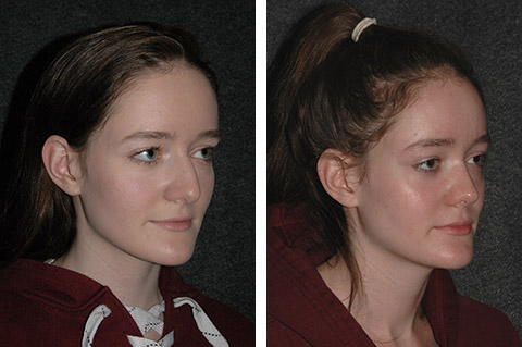 rhinoplasty patient photos new york rhinoplasty patient photos new york