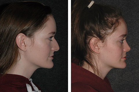 rhinoplasty patient photos rhinoplasty patient photos