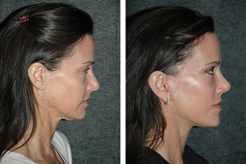 short scar facelift photos ny