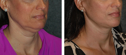 SMAS Facelift Before and After with Corrected Double Chin