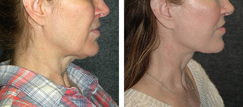 SMAS facelift patient Side view before & after