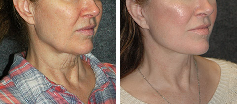 SMAS facelift patient photos with tightened neck