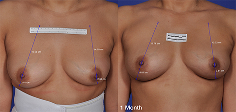 Thermitight Breast Skin Tightening before and after patient photos