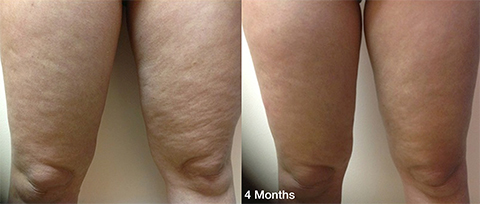 Thermitight Thigh Skin Tightening before and after patient photos