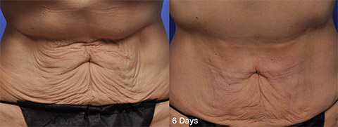 Thermitight Abdomen Skin Tightening before and after patient photos