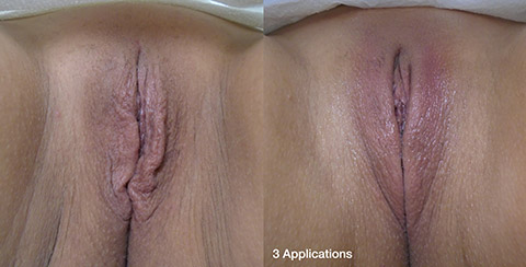 ThermiVa Vaginal Rejuvenation before and after patient 1 photos