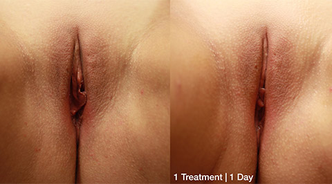 ThermiVa Vaginal Rejuvenation before and after patient 4 photos