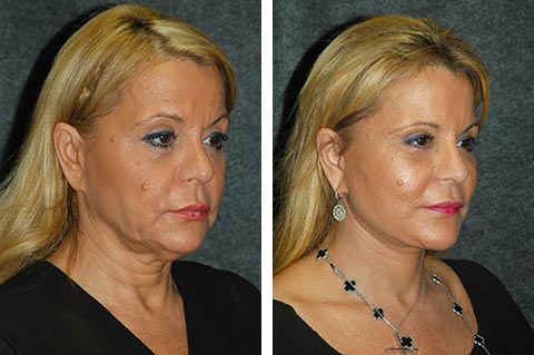 Facelift Photos | Before and After Facelift Pictures