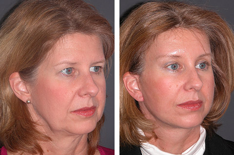 Lower Facelift photos - patient 1