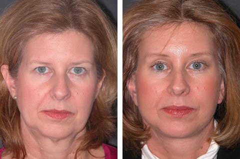 Lower Facelift photos - patient 1